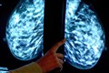 New model could offer personalised breast cancer screening approach, say experts