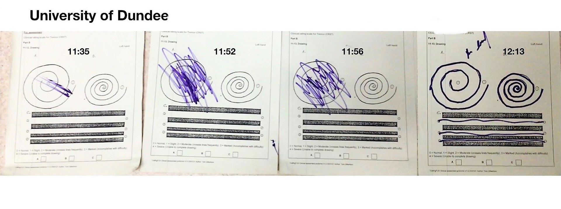 Spiral image tests done to show how treatment can reduce the vibrations in a patient's hands.