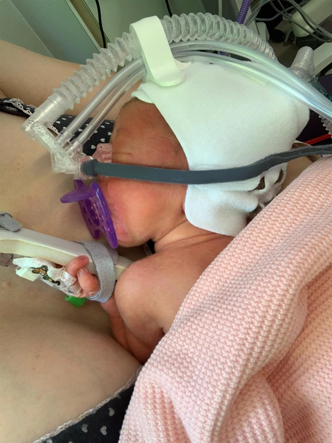 Tilly struggled to breathe after she was born.