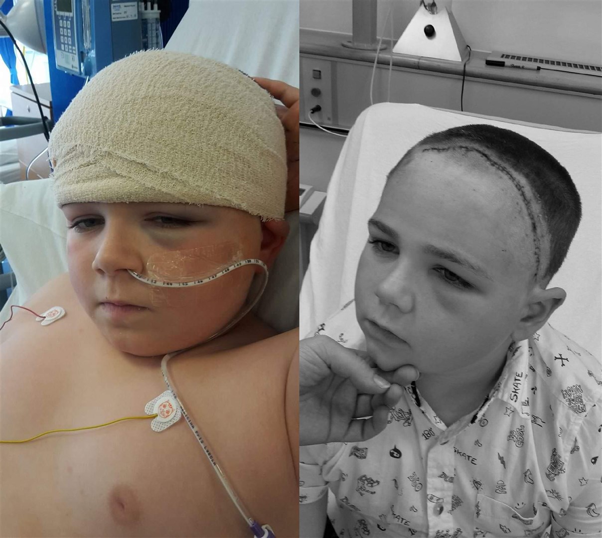 Lewis recovering following his surgery (left) and the scar after his bandages were removed.