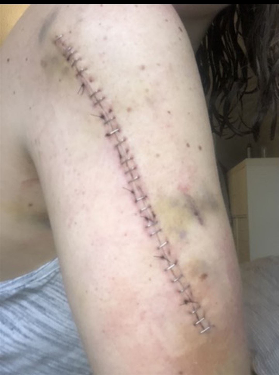 Megan Royle’s arm after surgeons operated, believing she had skin cancer (Hudgell Solicitors/PA)