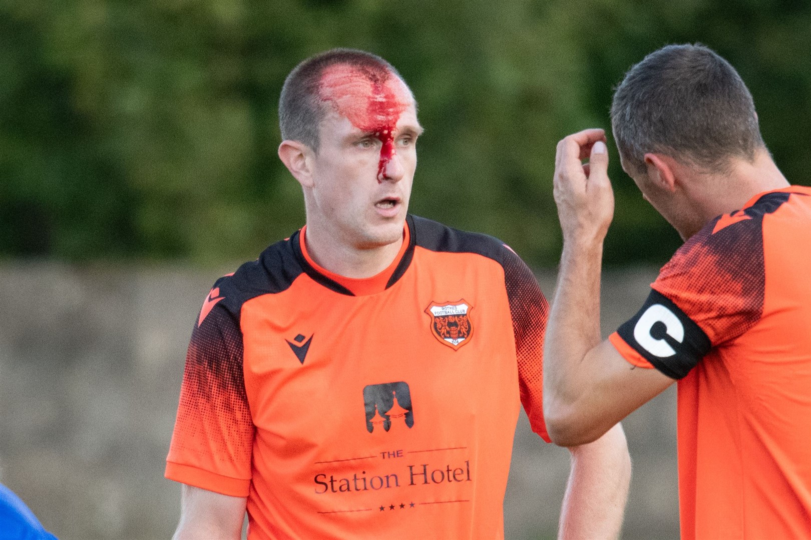 A split head for Rothes defender Charlie Macdonald. Picture: Daniel Forsyth